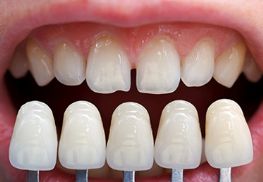 Αισθητική Οδοντιατρική - Διορθώστε απλά & εύκολα το χαμόγελό σας