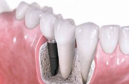 Οδοντικά Εμφυτεύματα-η καλύτερη επιλογή για την αντικατάσταση ενός δοντιού που χάθηκε