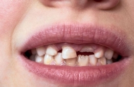 Όταν το πρώτο δόντι πέφτει… Πώς αισθάνονται τα παιδιά;